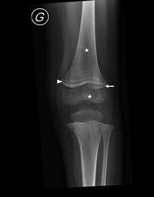 Scurvy: A New Old Cause of Skeletal Pain in Young Children